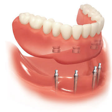 Miniature implants holding a set of attached dentures